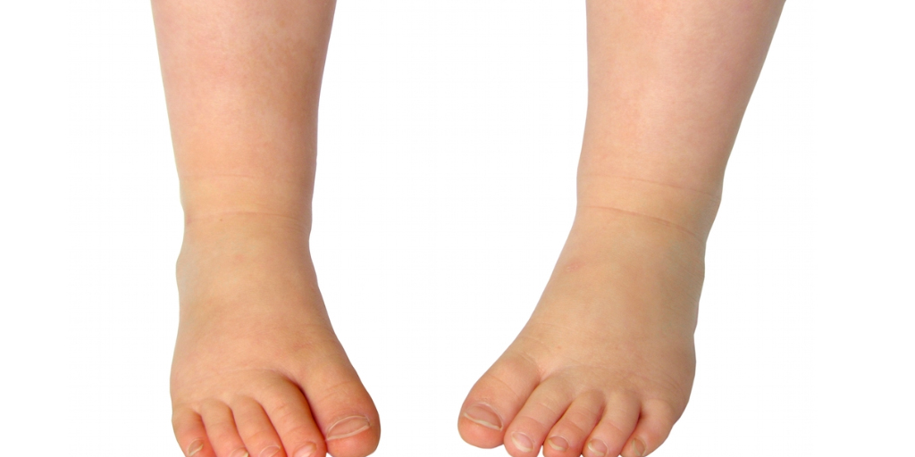 Pie Varo. Qué es, tipos y tratamiento Blog Body Help Pie Varo. Qué es, tipos y tratamiento Blog Body Help
